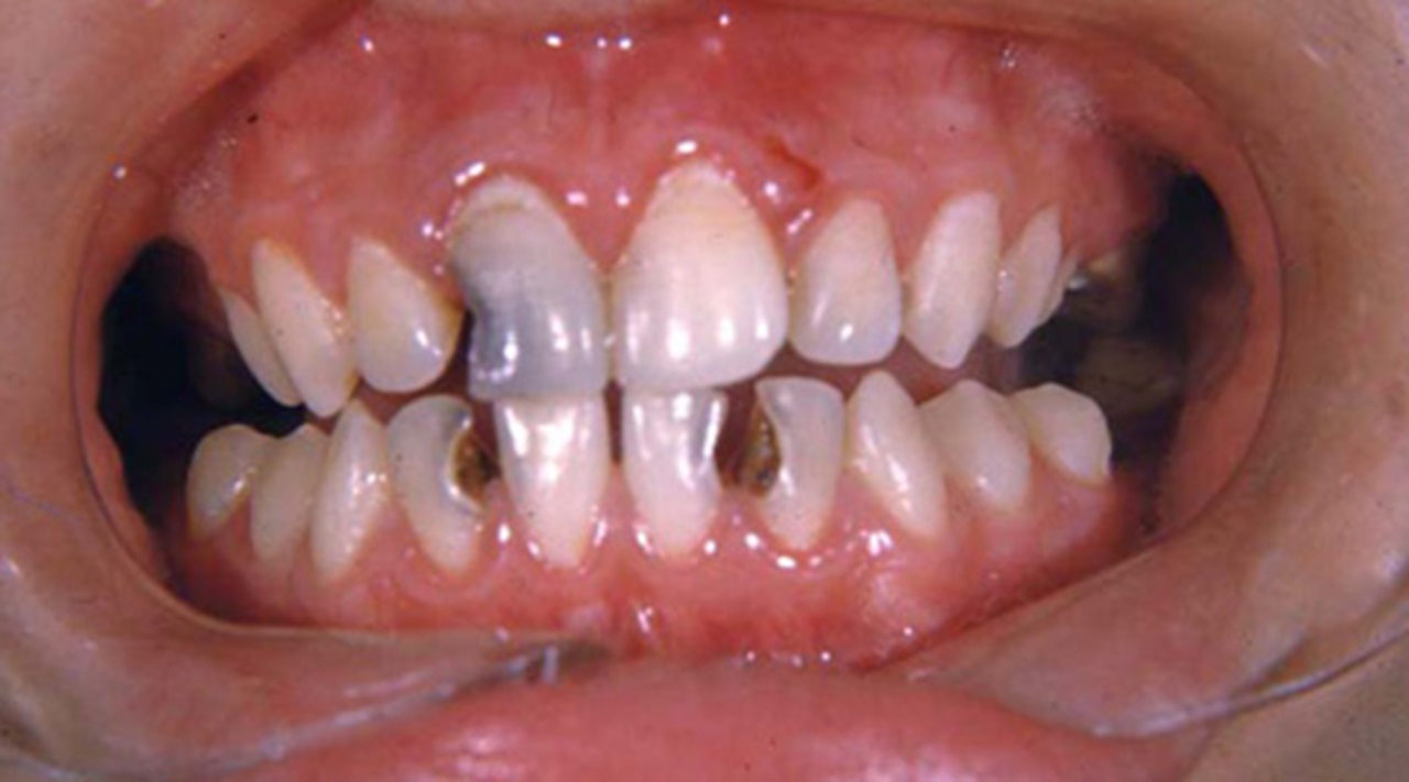 white gum infection