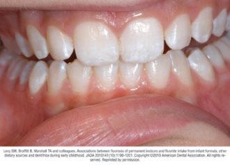 Fluorosis | MouthHealthy - Oral Health Information From The ADA