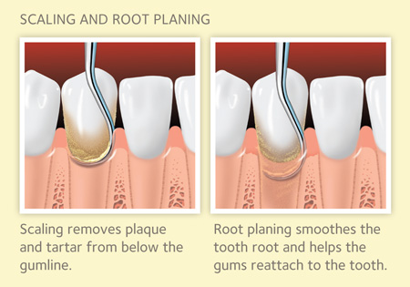 Scaling and Root Planing for Gum Disease MouthHealthy Oral